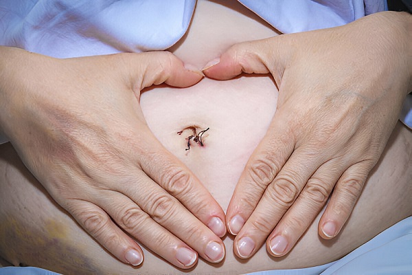 Best Gynaecological laparoscopic surgeon in Thane, Manpada